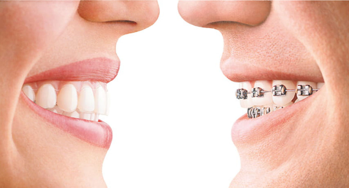 Invisalign vs braces